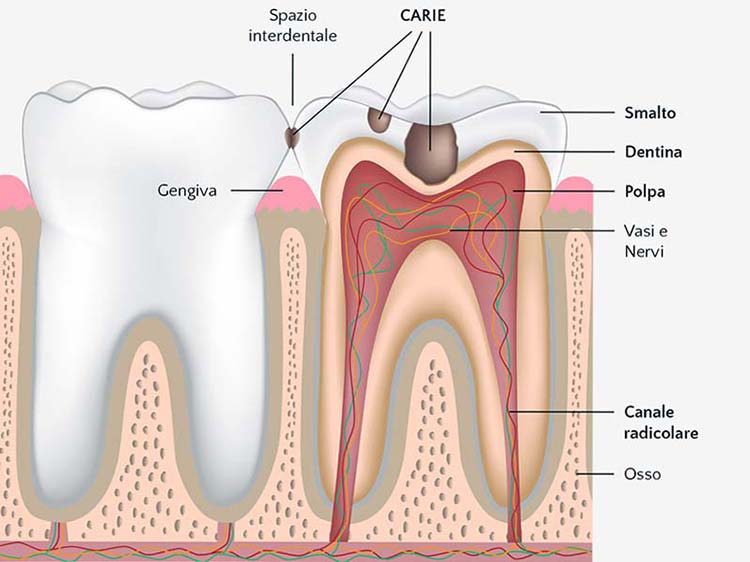 Otturazioni dentali - Centro Odontoiatrico Atena (BR)